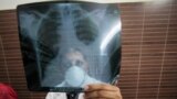 တီဘီရောဂါသည် လူနာ၏ x-ray ကို ဆရာဝန်က စစ်ဆေးကြည့်ရှု (AP Photo/Channi Anand)